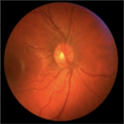 Raw retinal fundus photograph